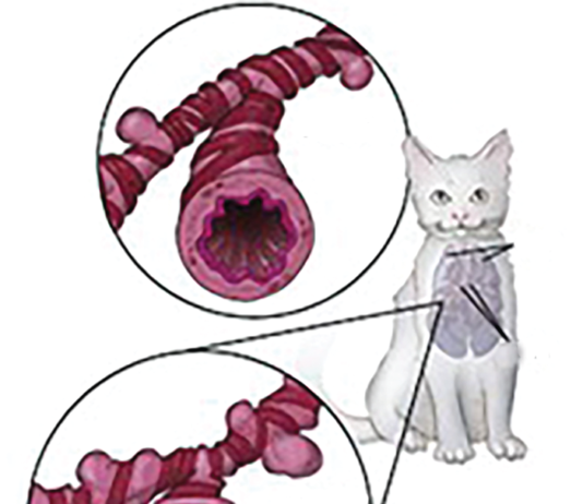Bronchioles in a normal lung allow air to pass freely. Asthmatic bronchioles are constricted and may accumulate fluid in the passages.