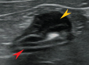 Sonographic image of a small intestinal lymphoma in a cat.